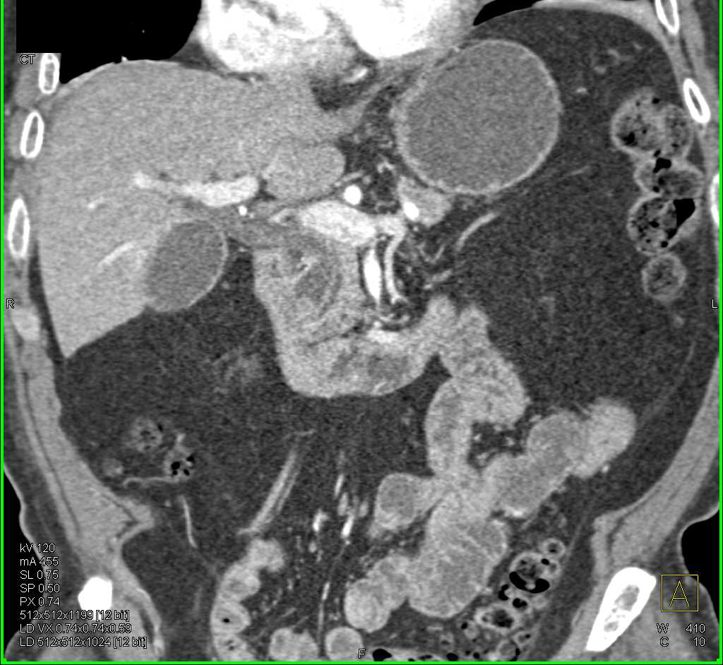 Ampullary Carcinoma with a Double Duct Sign - CTisus CT Scan