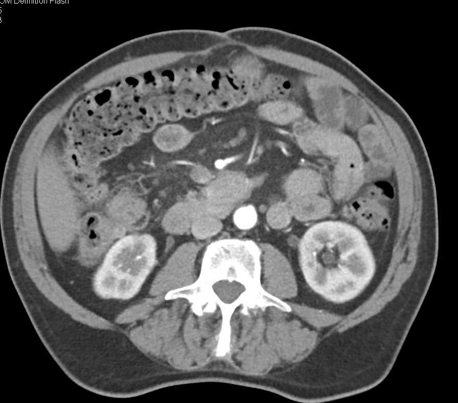 Hepatocellular Carcinoma (Hepatoma) in Right Lobe of Liver in a Cirrhotic Liver - CTisus CT Scan