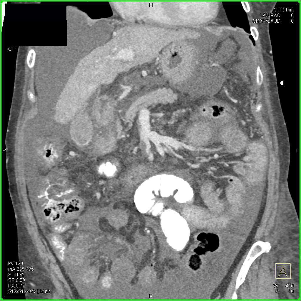 Cirrhosis with Ascites and Wet Bowel Pattern - CTisus CT Scan