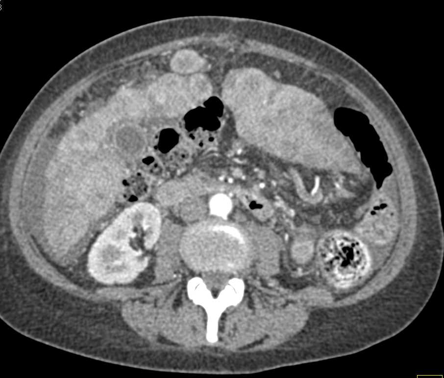 Metastatic Colon Cancer to Liver with Carcinomatosis - Liver Case