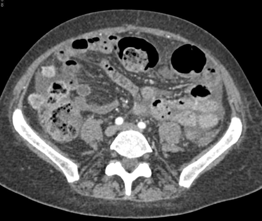 Metastatic Colon Cancer to Liver with Carcinomatosis - Liver Case