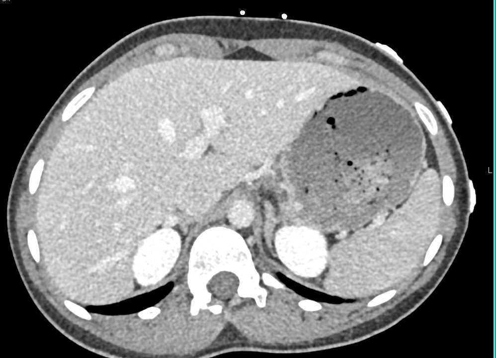 Hepatic Adenoma in the Right Lobe of the Liver - CTisus CT Scan