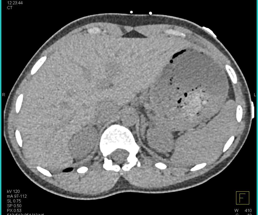 Hepatic Adenoma in the Right Lobe of the Liver - CTisus CT Scan