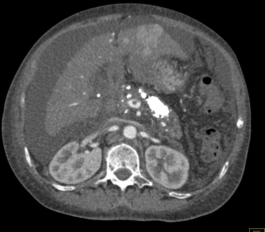 Multifocal Hepatocellular Carcinoma (Hepatoma) - CTisus CT Scan