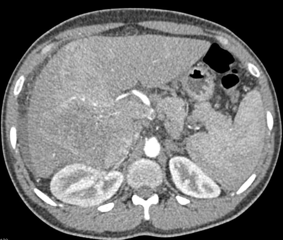 Hepatocellular Carcinoma (Hepatoma) in Right Lobe of Liver in a Cirrhotic Liver - CTisus CT Scan