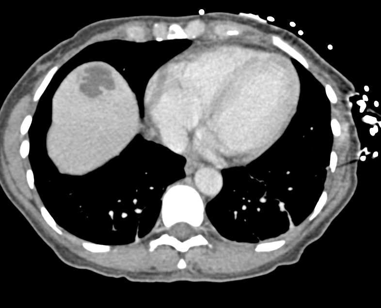 Liver Abscess - CTisus CT Scan