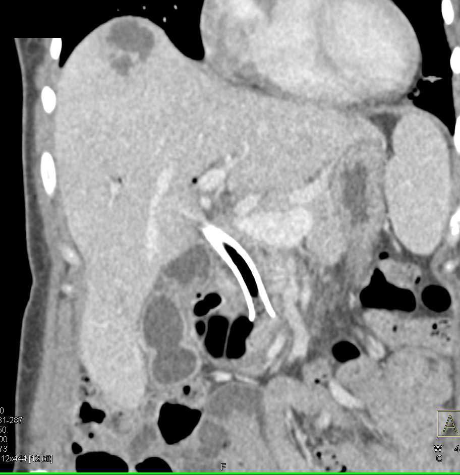 Liver Abscess Liver Case Studies Ctisus Ct Scanning