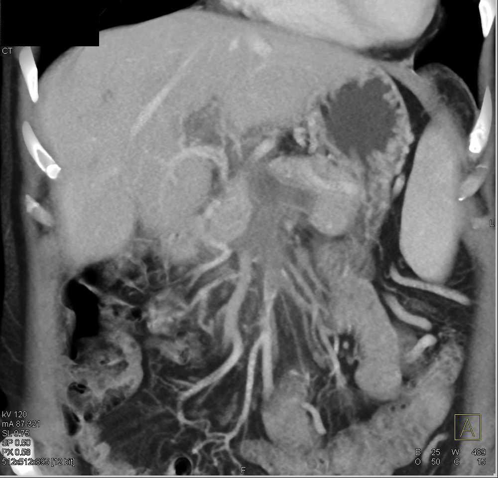 Cholangiocarcinoma Invades the Portal Vein and Superior Mesenteric Vein (SMV) - CTisus CT Scan