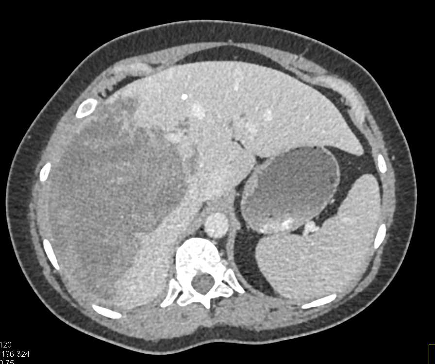 Cholangiocarcinoma of the Liver - CTisus CT Scan