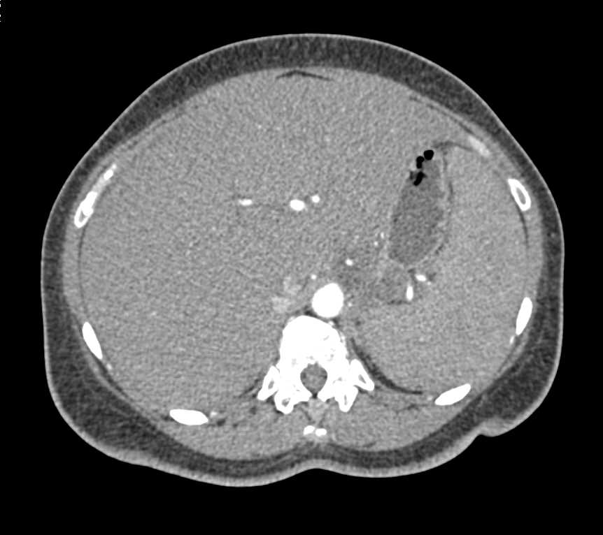 Budd-Chiari Syndrome with Perfusion Changes in the Liver - CTisus CT Scan