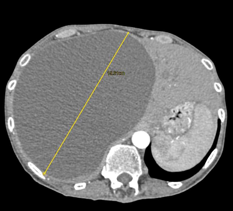 Large Simple Cyst of the Liver - Liver Case Studies - CTisus CT Scanning