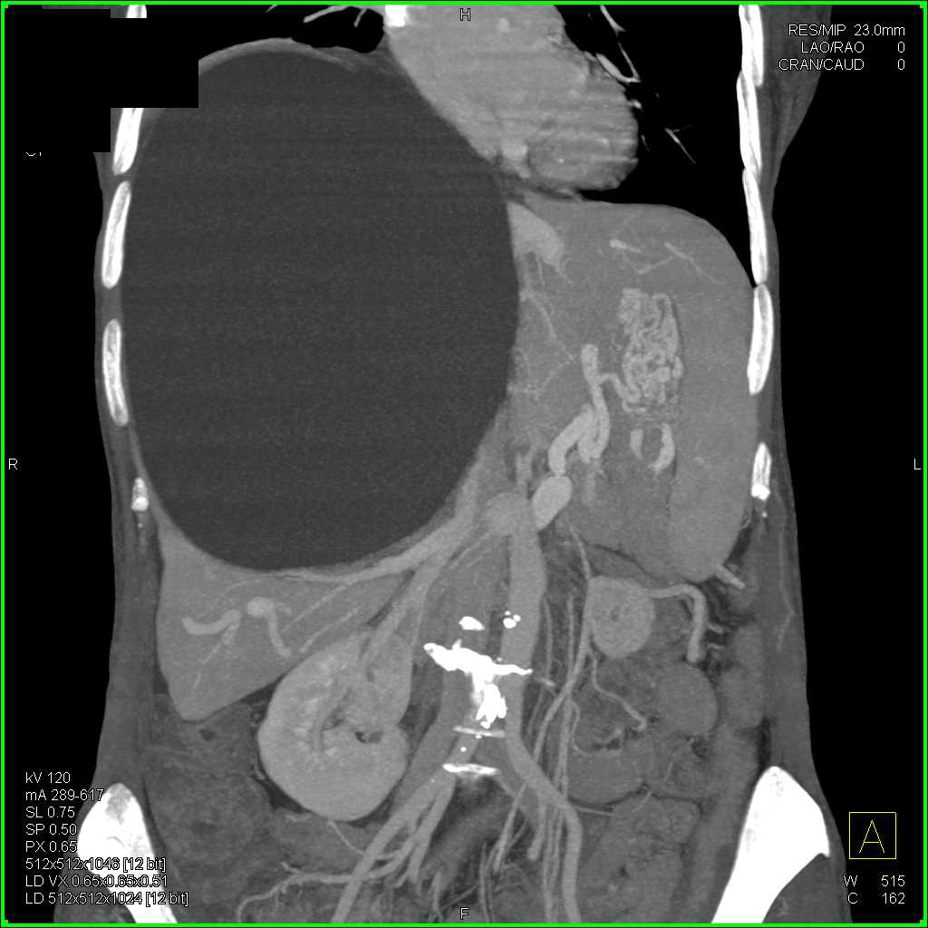 Large Simple Cyst of the Liver - Liver Case Studies - CTisus CT Scanning