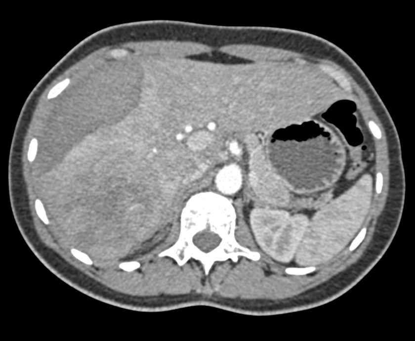 Hepatocellular Carcinoma (Hepatoma) with Bleed Following a Biopsy - CTisus CT Scan