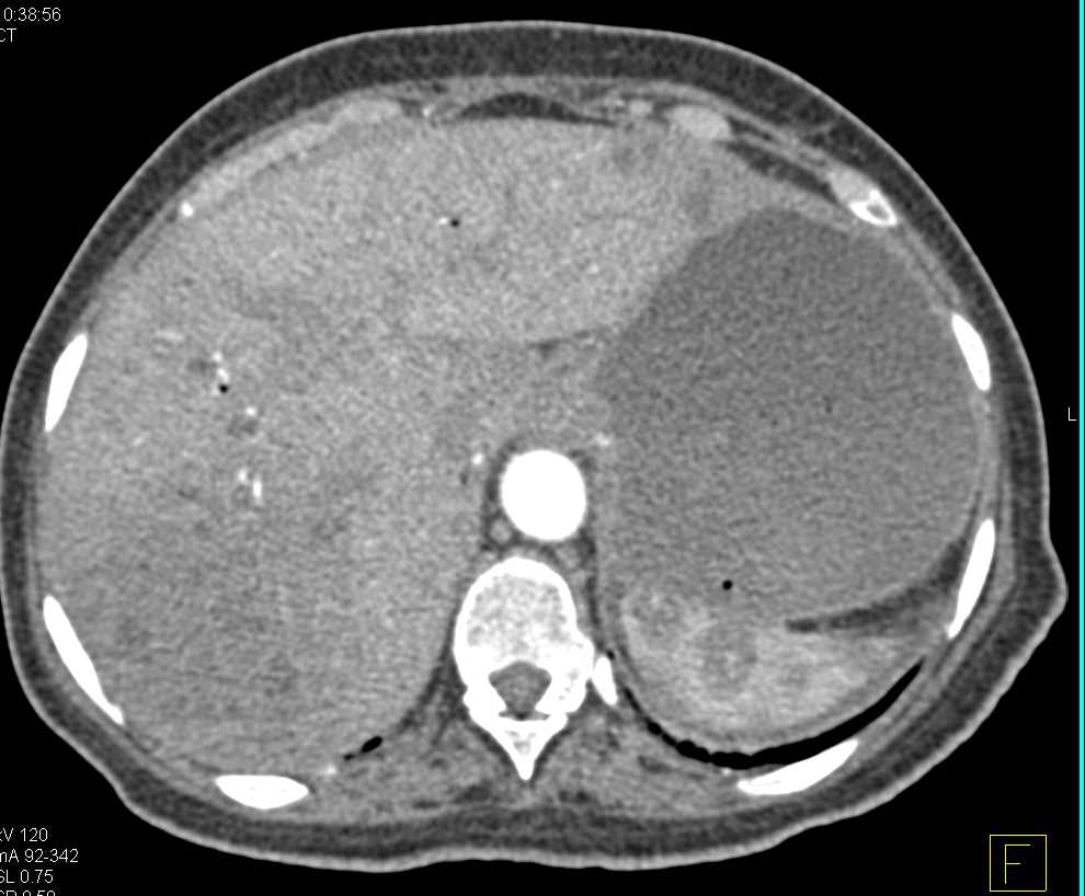 Multiple Liver Metastases - CTisus CT Scan