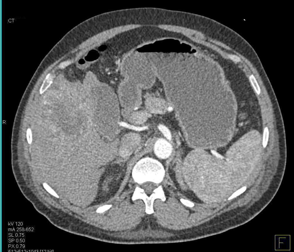 Hepatocellular Carcinoma (Hepatoma) with Neovascularity - CTisus CT Scan