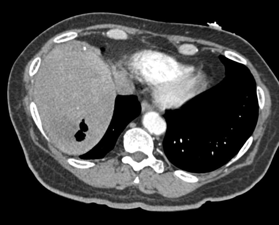 Liver Abscess with Air - Liver Case Studies - CTisus CT Scanning