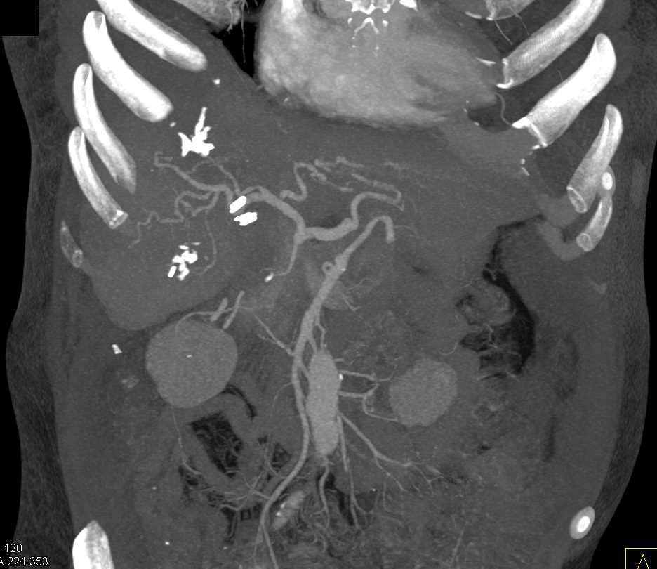 Liver Abscess With Air Liver Case Studies Ctisus Ct Scanning