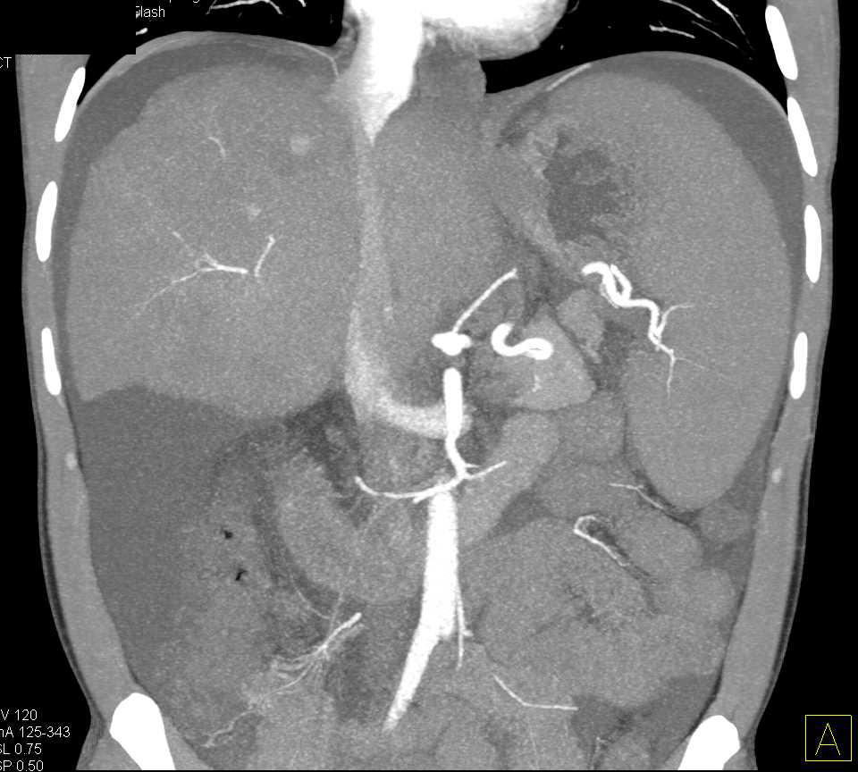 Hepatocellular Carcinoma (Hepatoma) in a Cirrhotic Liver - CTisus CT Scan