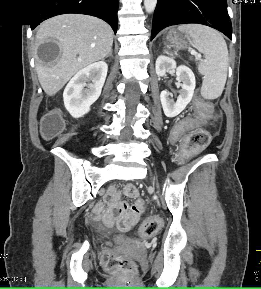 Liver Abscess Simulates a Metastases in a Patient Post Whipple Procedure - CTisus CT Scan