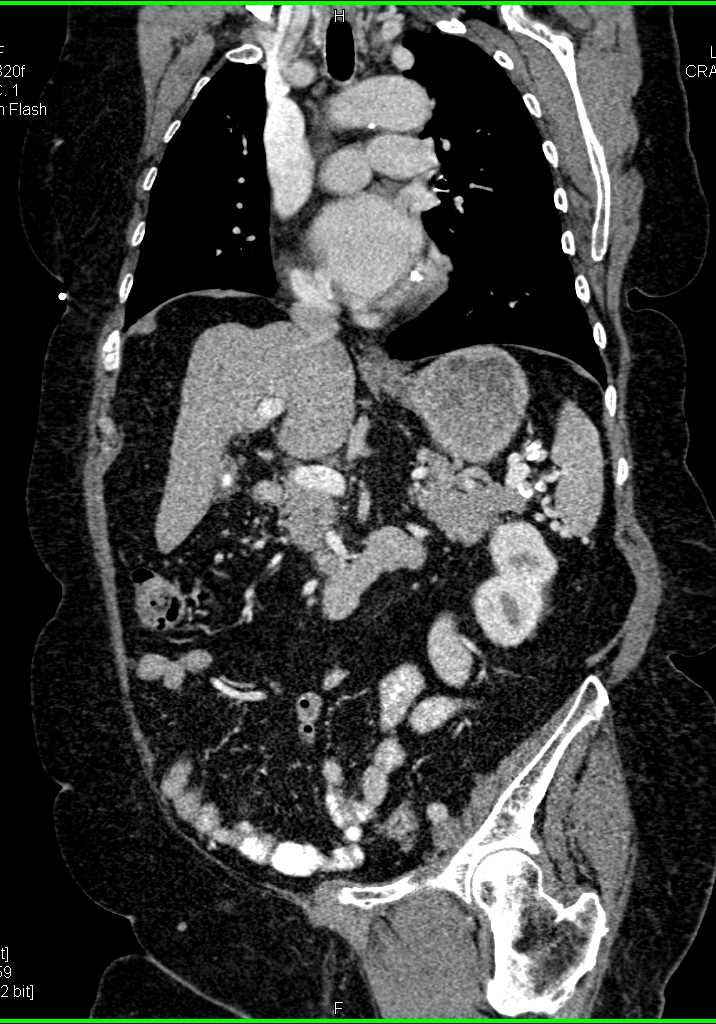 Cirrhosis with Portal Hypertension - CTisus CT Scan