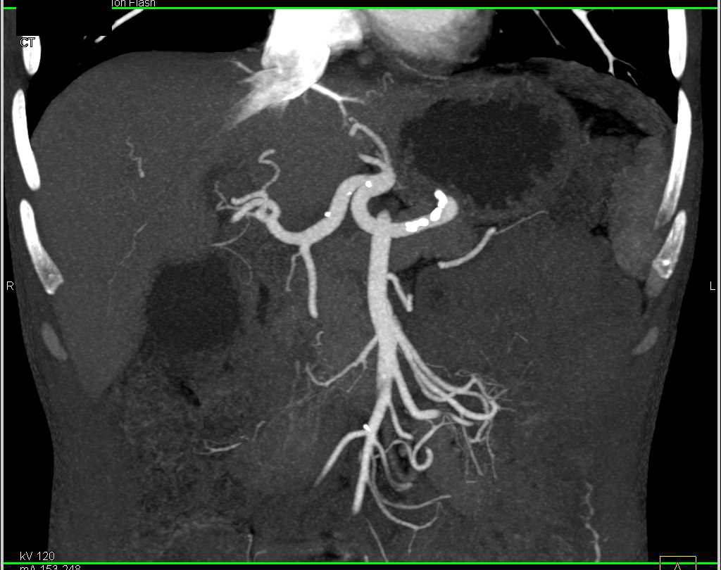 Dilated Common Bile Duct (CBD) with Ampullary Carcinoma - CTisus CT Scan