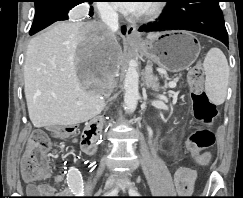 Recurrent Cholangiocarcinoma in Patient with Inferior Vena Cava (IVC) Grafting - CTisus CT Scan