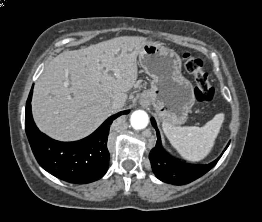 Cholangiocarcinoma with Adenopathy - CTisus CT Scan