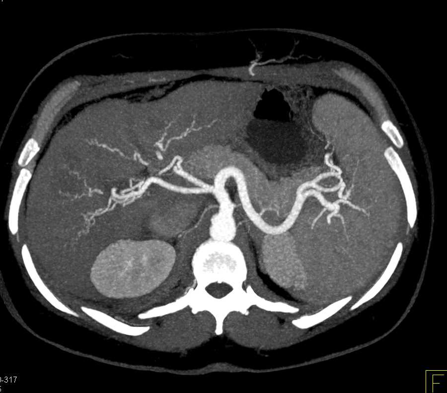 Arteriovenous (AV) Shunting in a Cirrhotic Liver - CTisus CT Scan