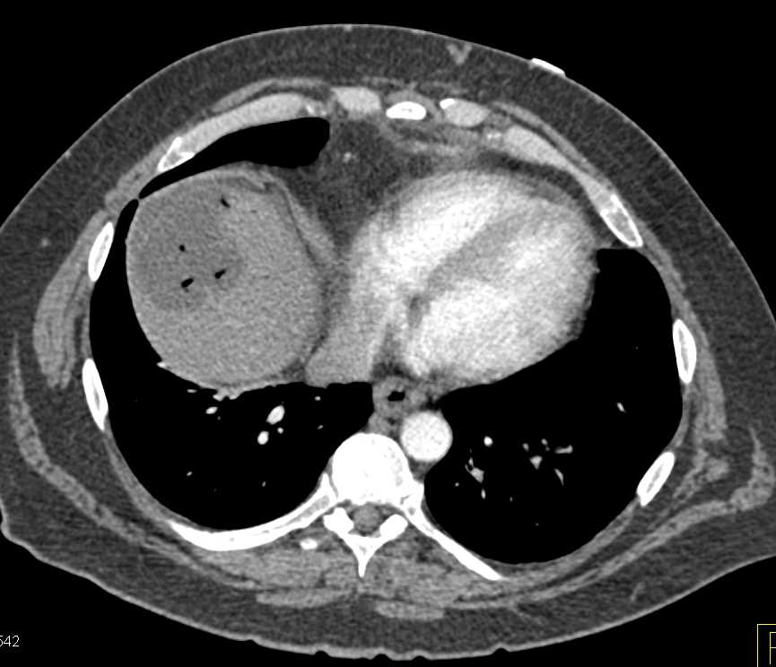 Liver Abscess in Patient with Pancreatic Cancer s/p Whipple Procedure - CTisus CT Scan