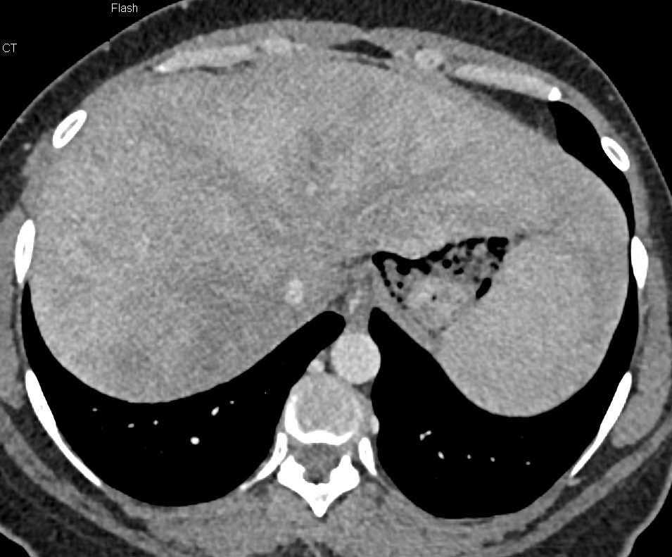 Passive Congestion of the Liver - CTisus CT Scan