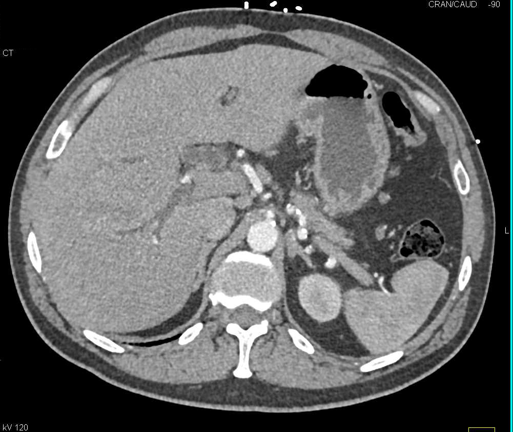 Hepatocellular Carcinoma (Hepatoma) with Spontaneous Bleed - CTisus CT Scan