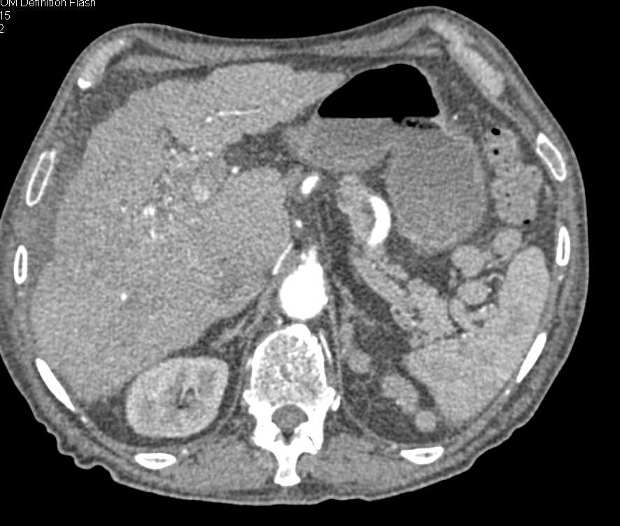 Hepatocellular Carcinoma (Hepatoma) with Portal Vein Invasion in a Cirrhotic Liver - CTisus CT Scan