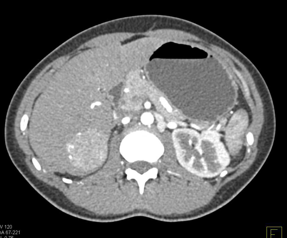 Focal Nodular Hyperplasia (FNH) Right Lobe of the Liver - CTisus CT Scan