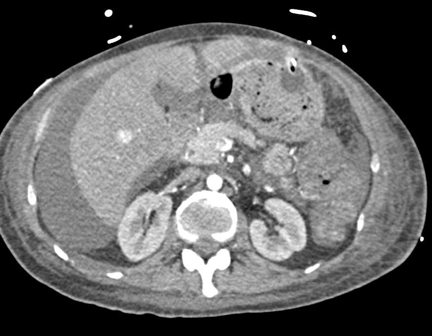 Multifocal Hepatocellular Carcinoma (Hepatoma) Best Seen With MIP Imaging - CTisus CT Scan