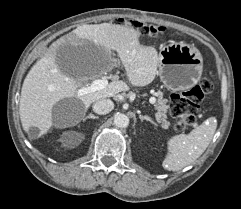 Gallbladder Cancer - CTisus CT Scan