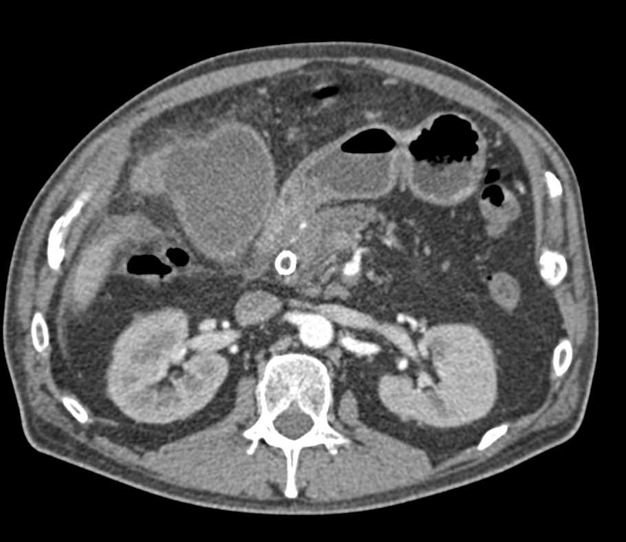 Acute Cholecystitis in a Patient with Pancreatic Cancer - CTisus CT Scan