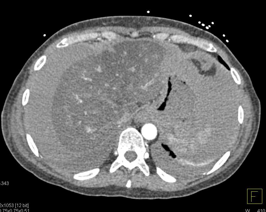 Hemoperitoneum in Patient with Cirrhosis and Liver Failure - CTisus CT Scan