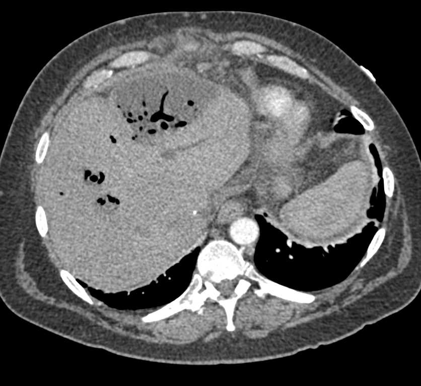 Liver Infarct with Abscess - CTisus CT Scan