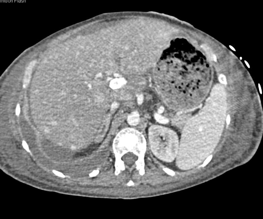 Budd-Chiari with Regenerative Nodules and Transjugular Intrahepatic Portosystemic Shunt (TIPS) Catheter - CTisus CT Scan