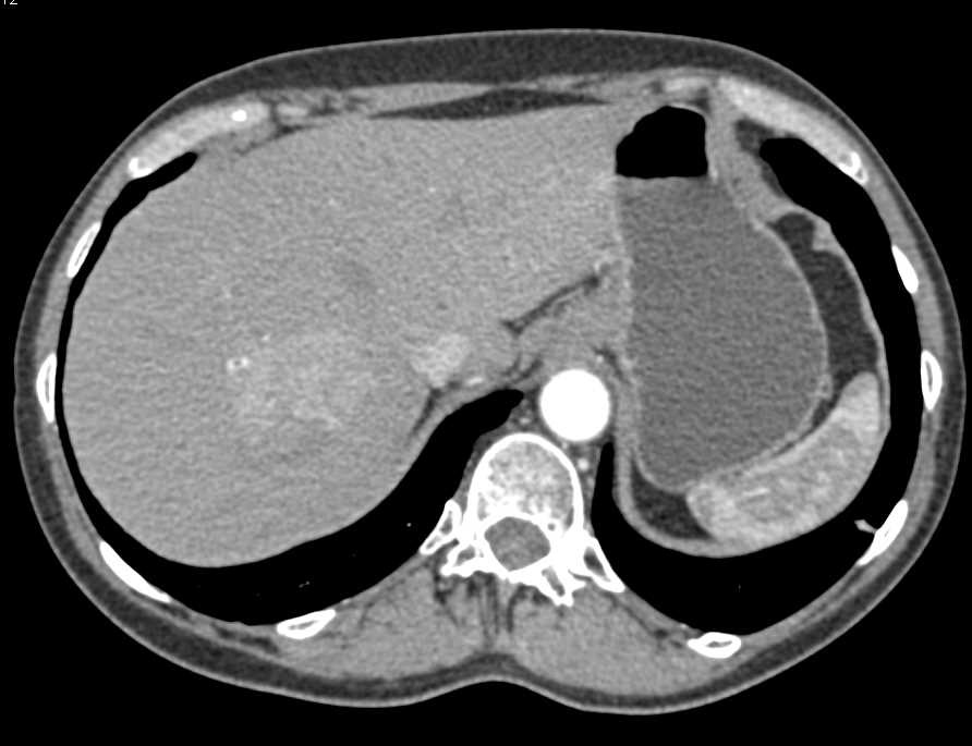 Focal Nodular Hyperplasia Liver - CTisus CT Scan