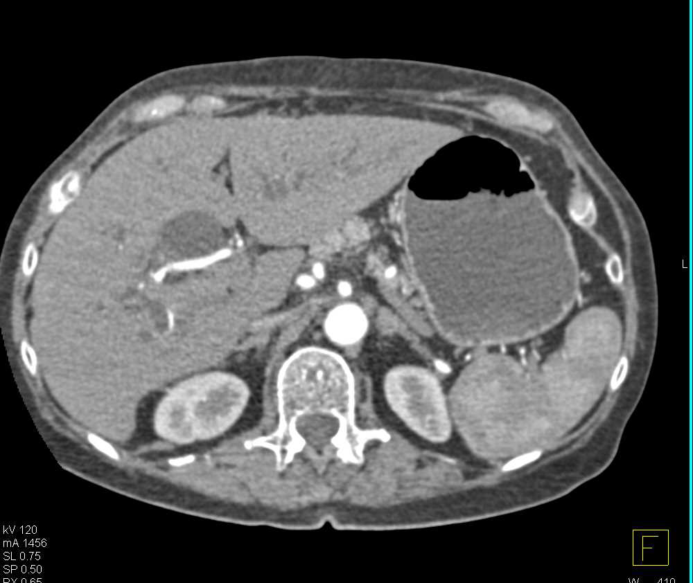 Ampullary Carcinoma Obstructs the Common Bile Duct - CTisus CT Scan