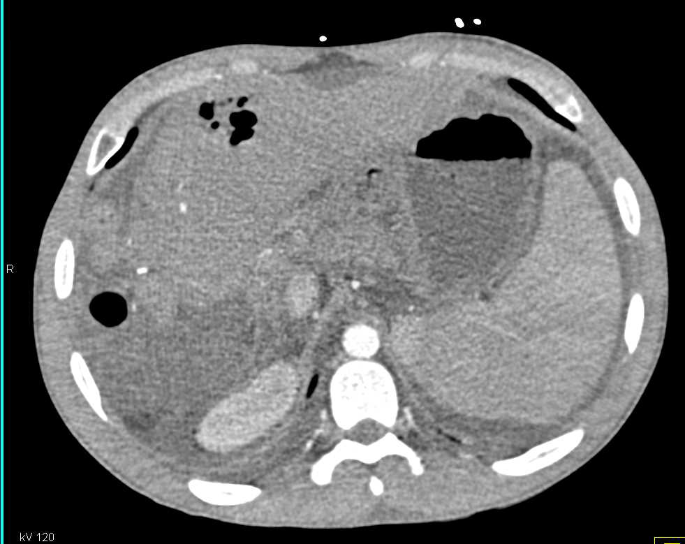 Hepatic Abscess Following Pancreatic Surgery - CTisus CT Scan