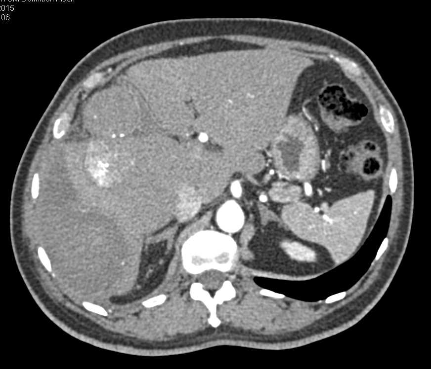 Hepatocellular Carcinoma (Hepatoma) with Spontaneous Bleed - CTisus CT Scan