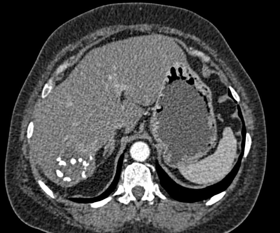 Sclerosing Hemangioma of the Liver - CTisus CT Scan