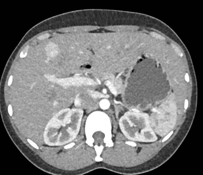 Focal Nodular Hyperplasia (FNH) Liver - CTisus CT Scan