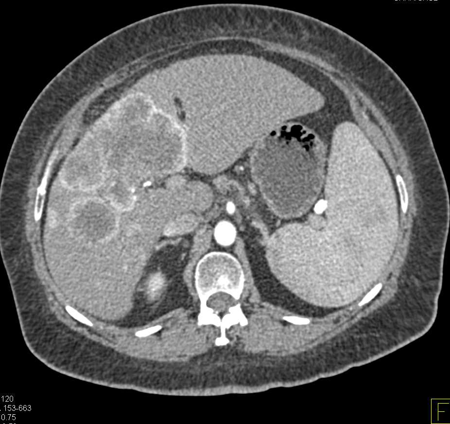 Intrahepatic Cholangiocarcinoma - CTisus CT Scan