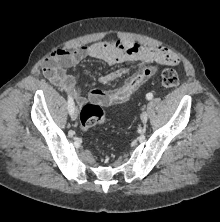 Liver and Splenic infarcts and Abscesses - CTisus CT Scan