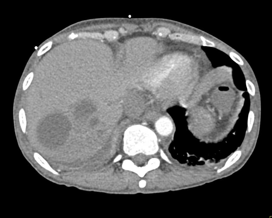 Liver Abscess due to Diverticulitis - CTisus CT Scan