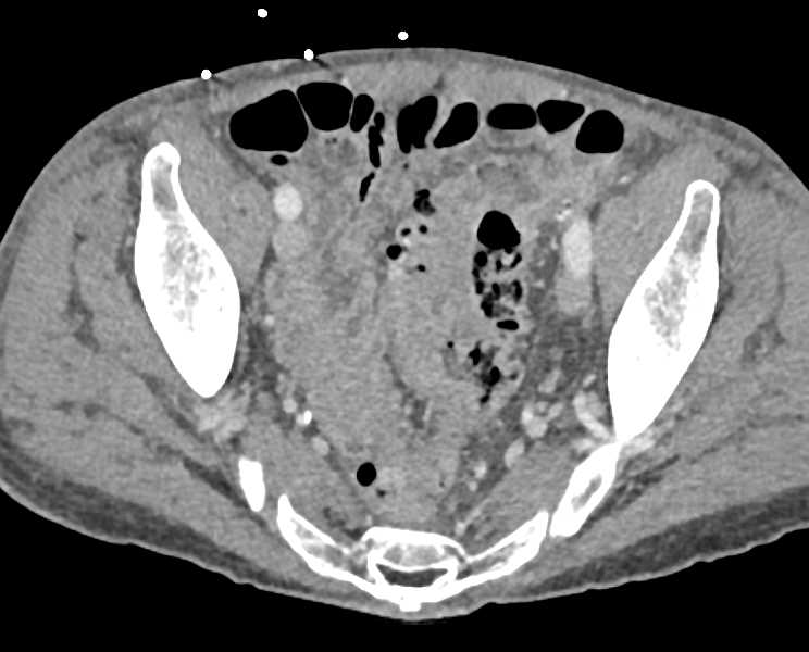 Liver Abscess Due To Diverticulitis Liver Case Studies Ctisus Ct