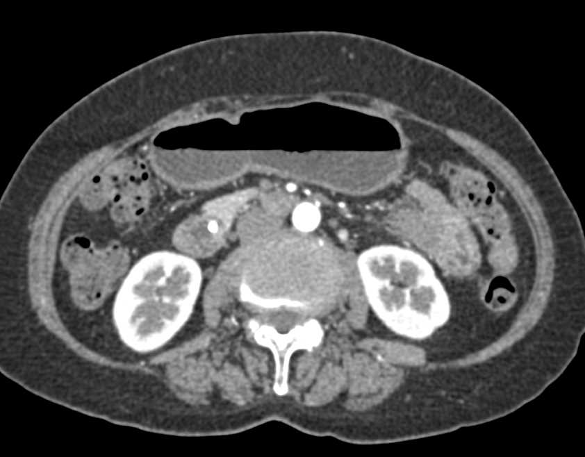 Ampullary Cancer Obscured by Stent in Common Bile Duct (CBD) - CTisus CT Scan